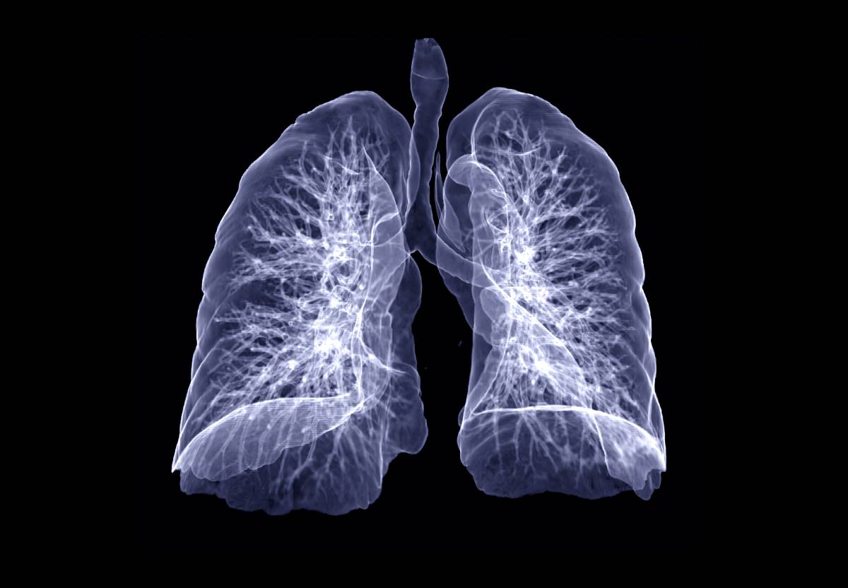 Ventilator-Induced Lung Injury: Research and Prevention