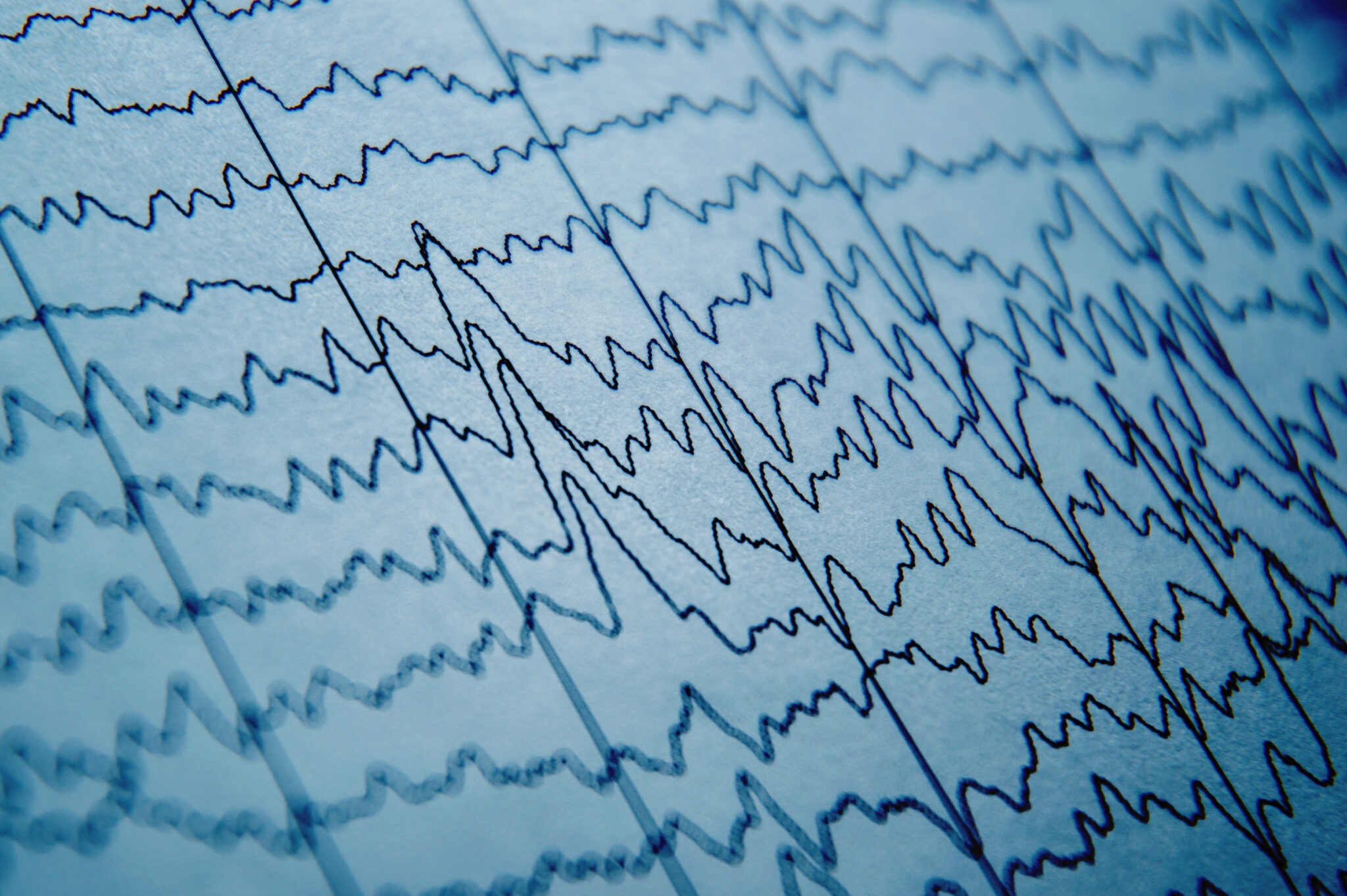 Machine Learning To Predict Anesthesia Depth From EEG - Radius ...